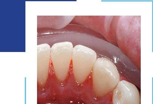 Home Teeth Cleaning Solutions That Promote Oral Health